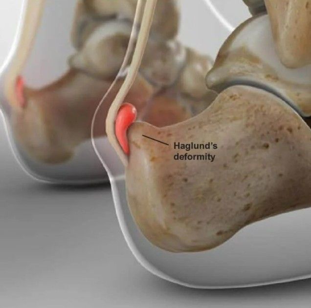 Sindrome de Haglund