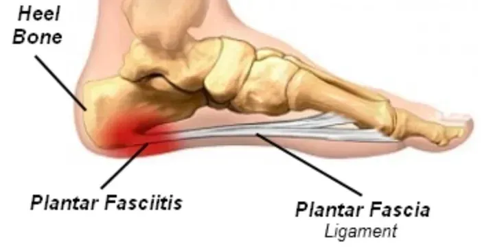 Inflamacao de fascite plantar e esporao do calcaneo
