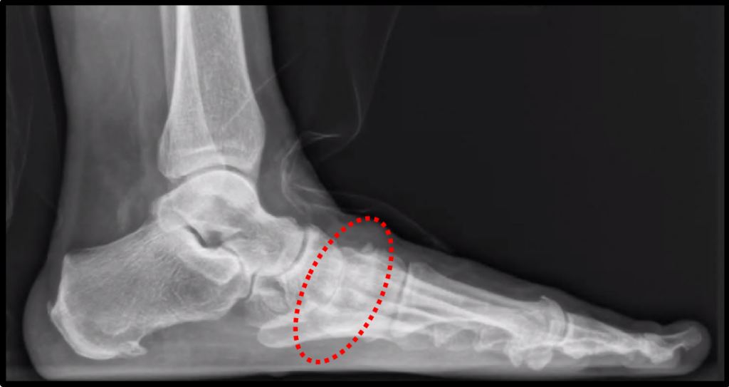 Artrose Tarso Metatarsal do pé