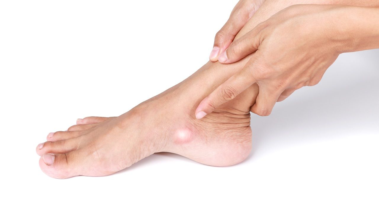Navicular acessório