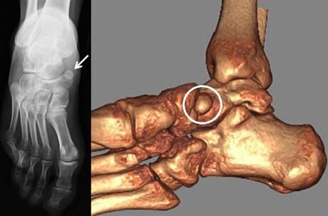diagnóstico Navicular acessório