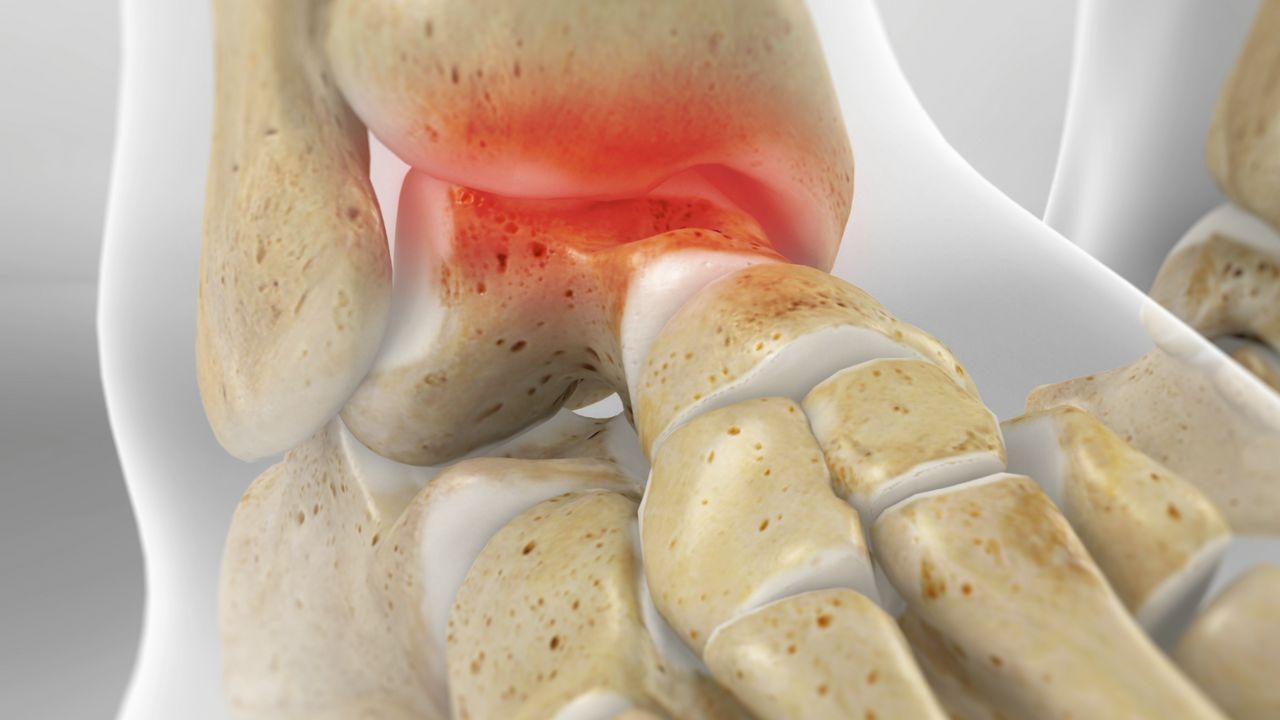 Lesão Osteocondral no Tornozelo