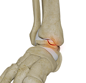 Lesão Osteocondral no Tornozelo