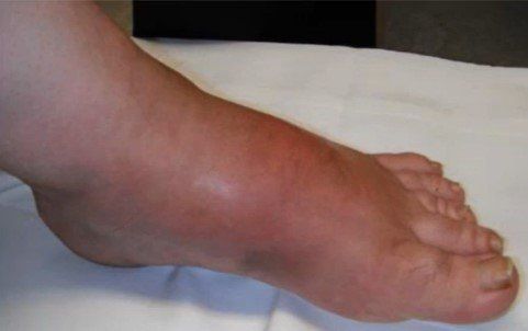 pé de Charcot