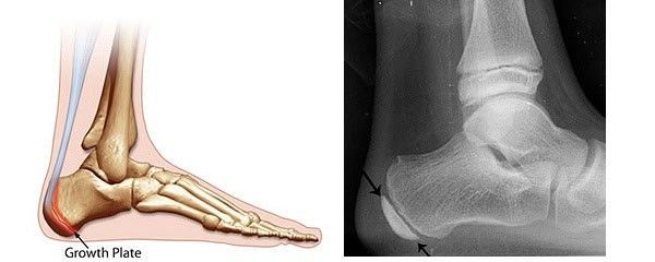 osteocondrite de sever