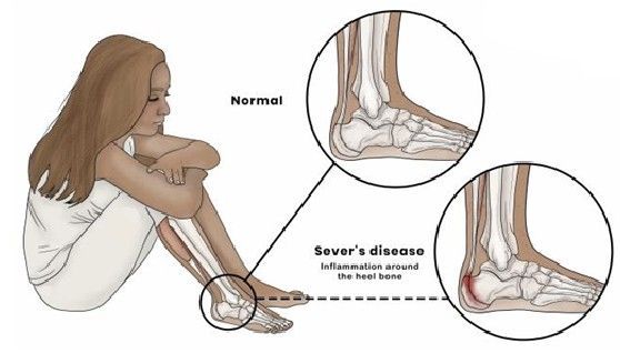 osteocondrite de sever