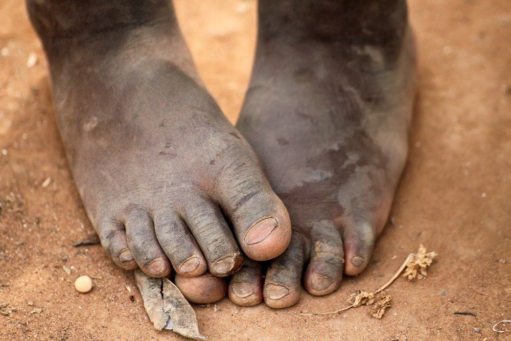 Feet Nail Care — Fungal Nail Treatments in Urunga, NSW