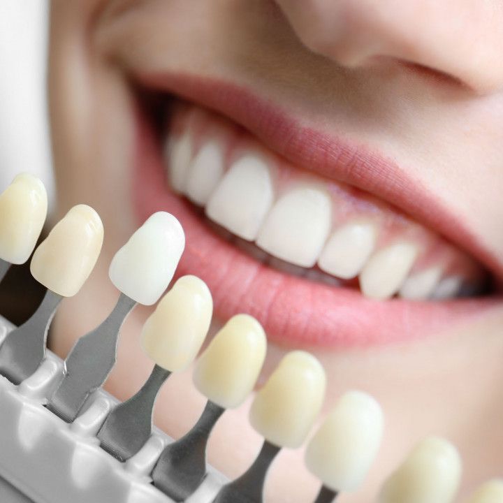 Dental Crowns