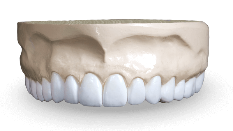 Diagnostic Wax-Ups
