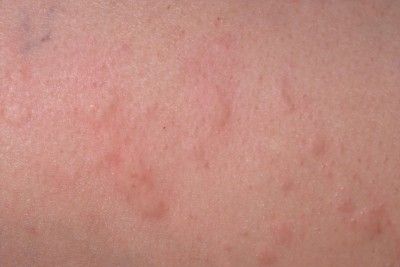 close-up of skin with a rash caused by bed bugs