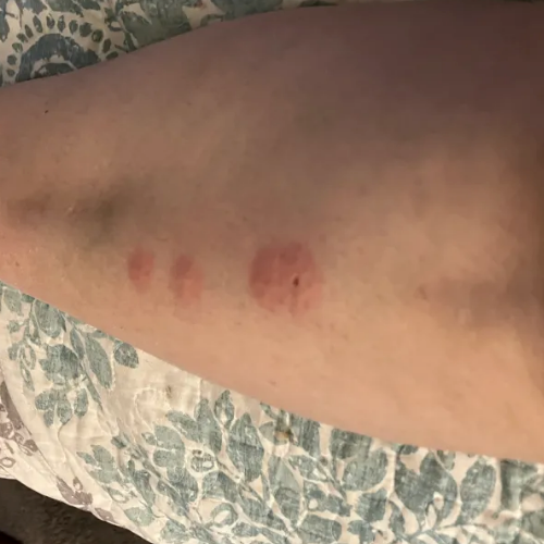 Bed bug bits on human leg in Las Vegas Hotel
