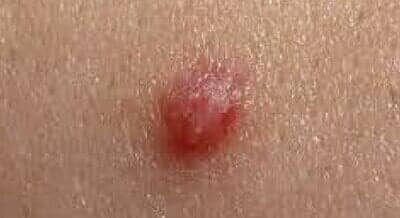 DRA. TERESA SANDOVAL SANDOVAL - Infección sexualmente transmitida