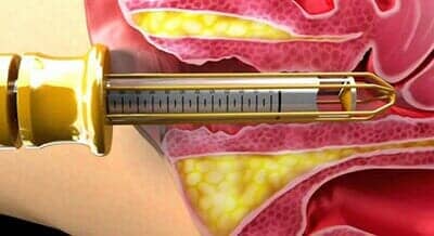 DRA. TERESA SANDOVAL SANDOVAL - Operación vaginal