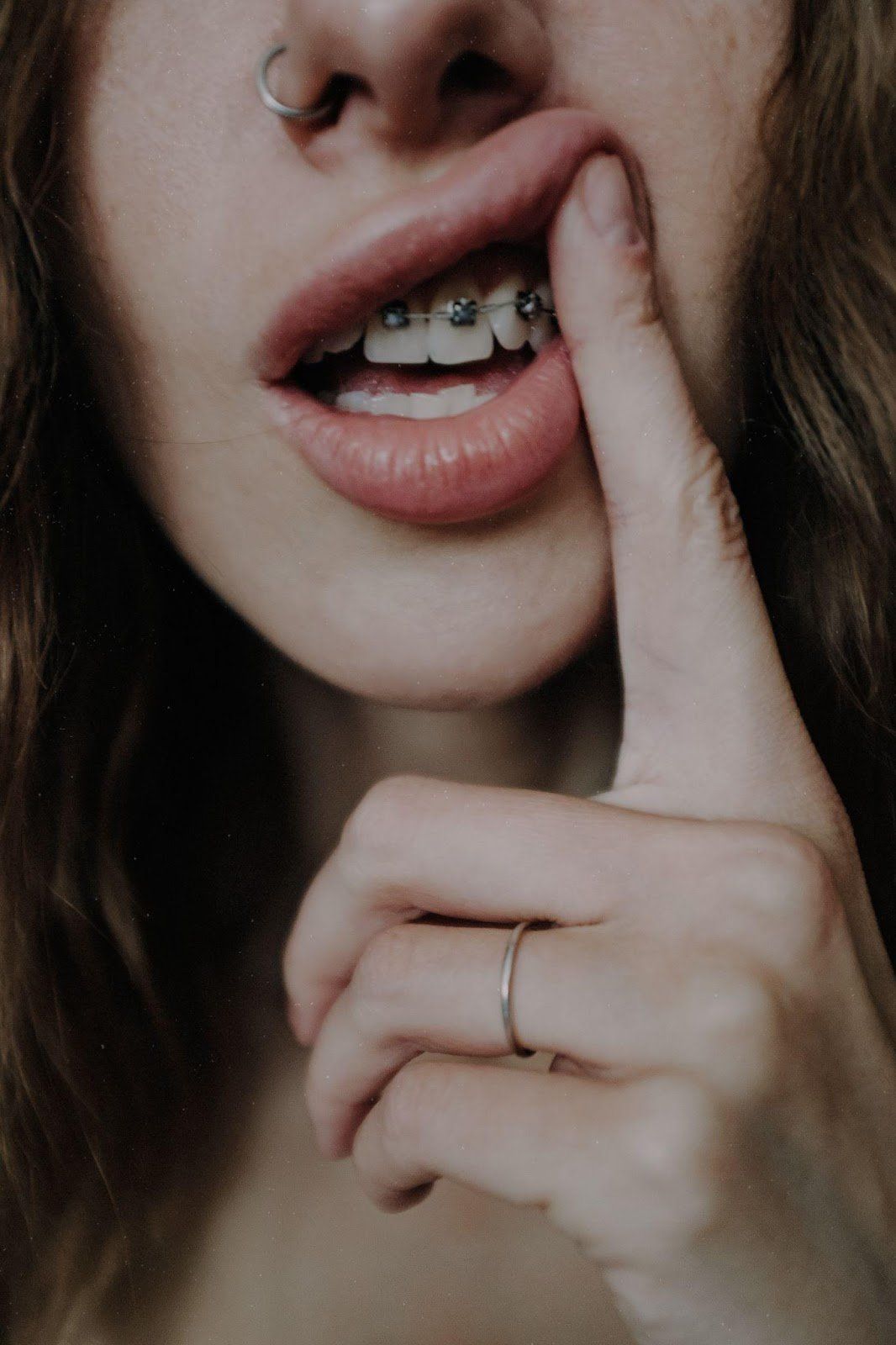 teeth whitening brooklyn