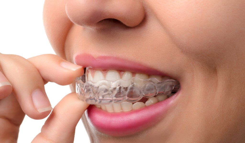 teeth whitening brooklyn