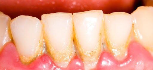 teeth whitening brooklyn