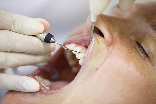 DENTAL IMPLANTS