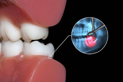teeth whitening brooklyn