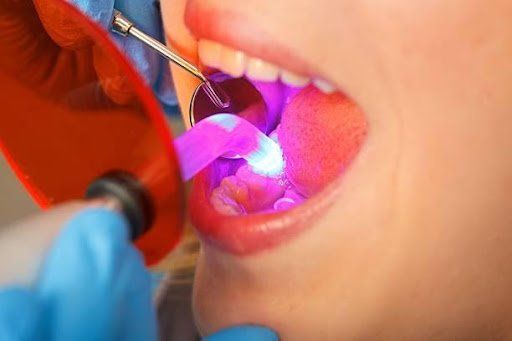 dental implants brooklyn