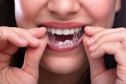 teeth whitening brooklyn