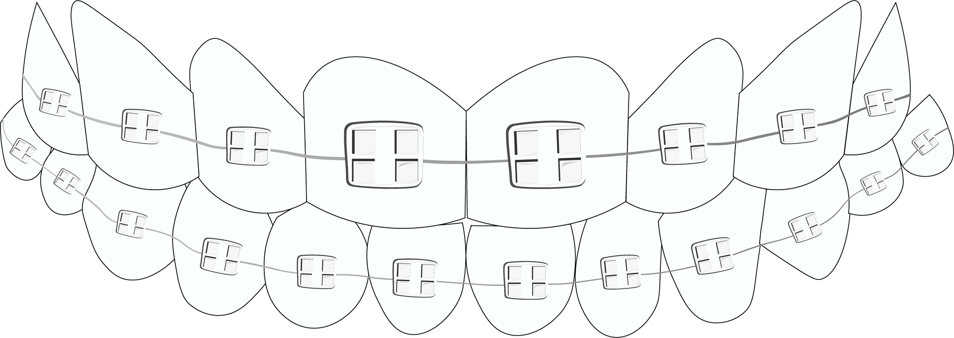 ceramic braces