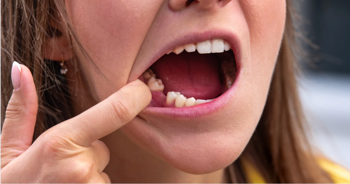 How Missing Teeth Impact Your Health