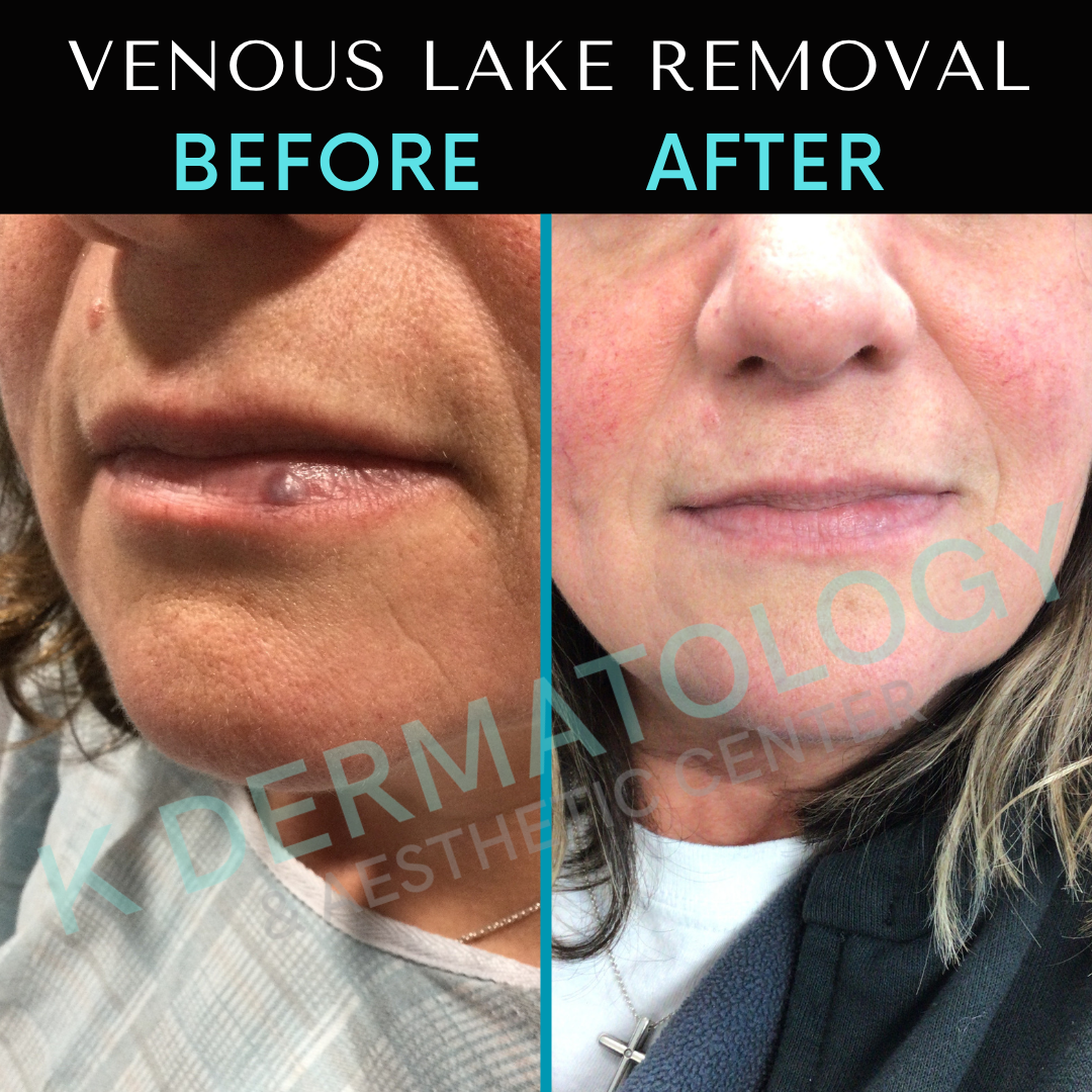 Before-and-after close-up of a chin and jawline, showing reduced neck and chin fat after Venous Lake removal.