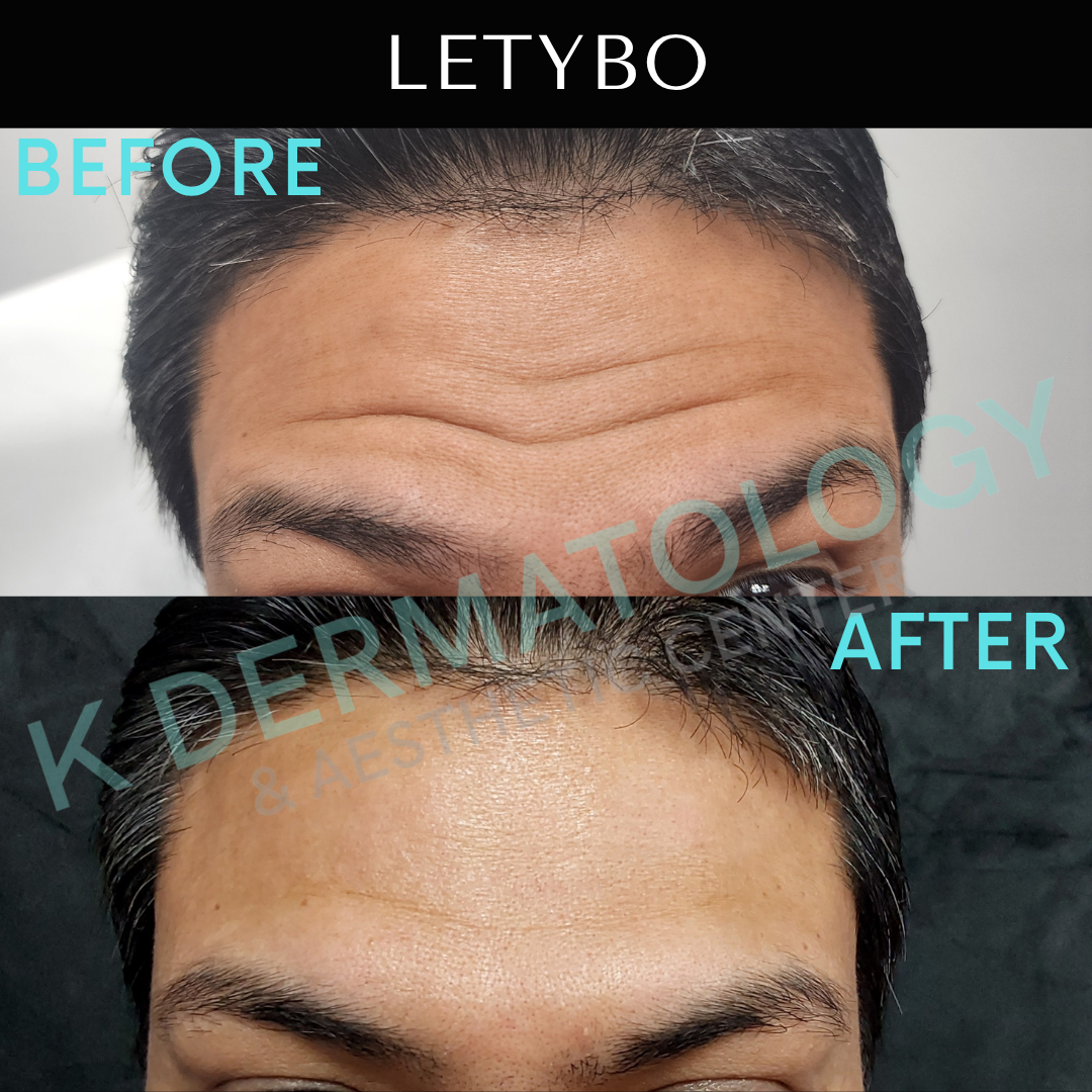 Before-and-after close-up of forehead lines and smoother skin, labeled LETYBO.