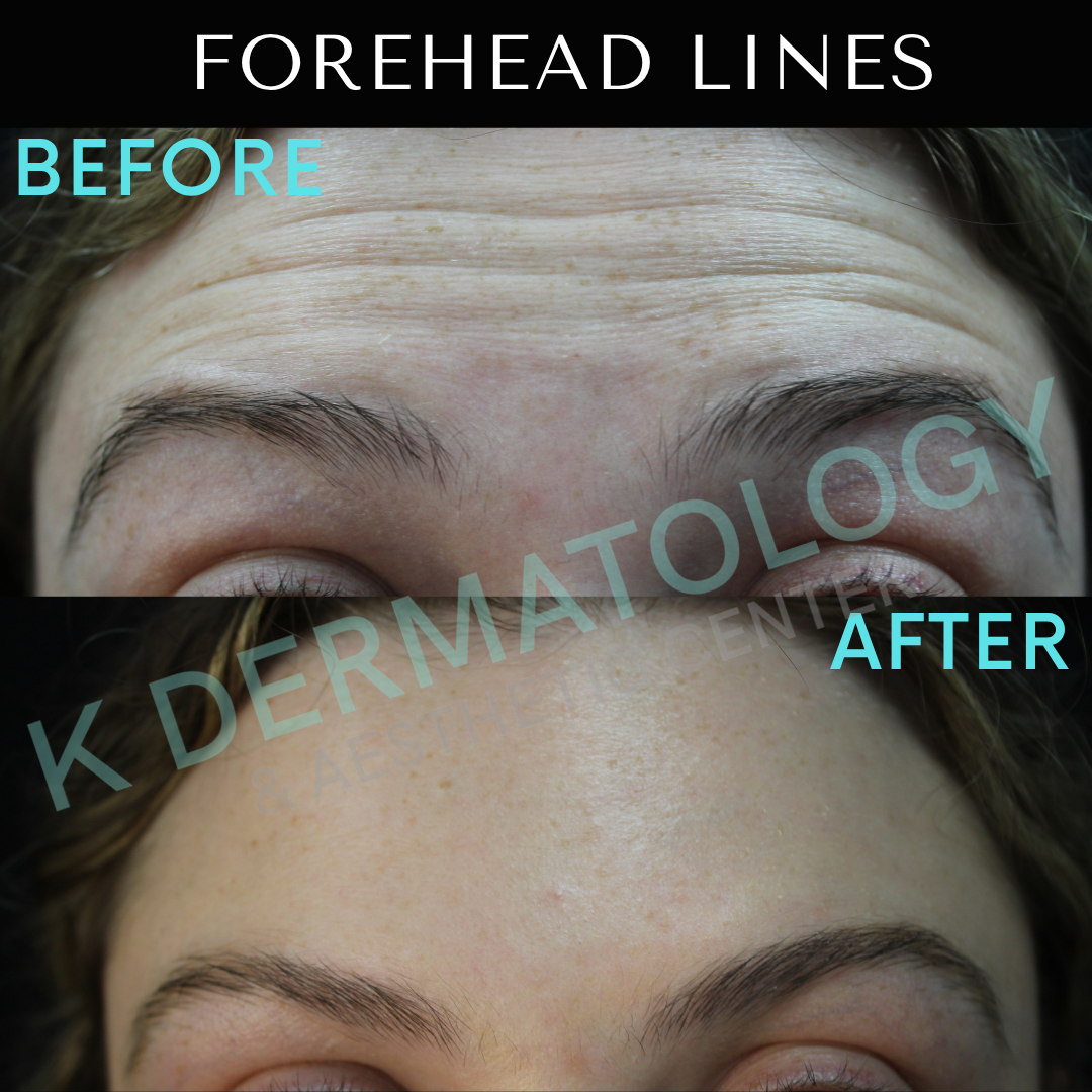 Before-and-after close-up of forehead lines, showing smoother skin after treatment.