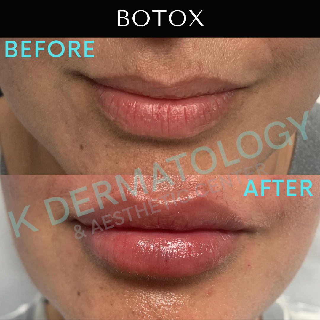 Before-and-after close-up of lips labeled “Botox,” showing fuller, glossier lips after treatment.