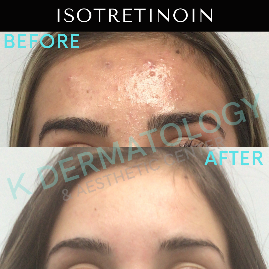 Before-and-after forehead acne treatment results, labeled “ISOTRETINOIN,” showing clearer skin after treatment