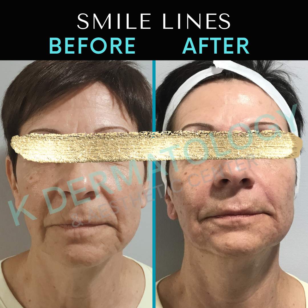 Before-and-after face comparison labeled “Smile Lines,” showing reduced wrinkles after treatment.