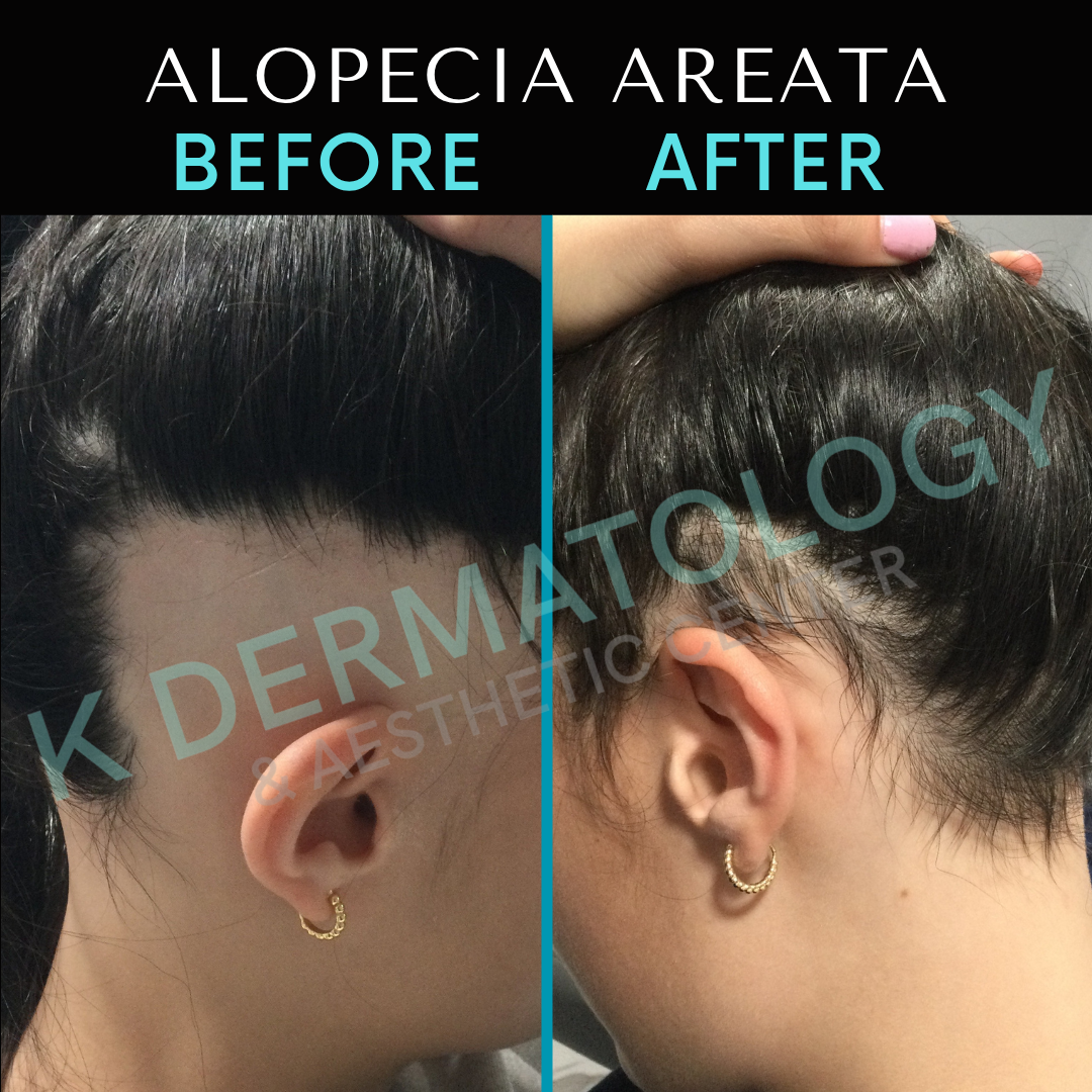 Before-and-after scalp photos showing alopecia areata hair loss and regrowth.