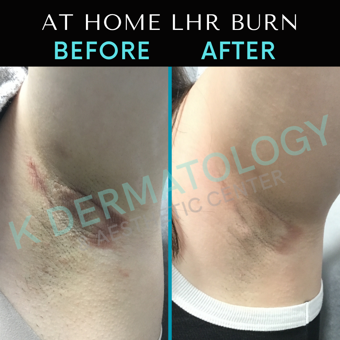 Before-and-after close-up of an armpit burn, showing redness healing to darker skin.