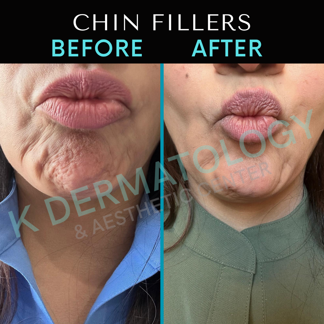 Chin fillers before-and-after close-up, split-screen of lower face with fuller chin profile on right