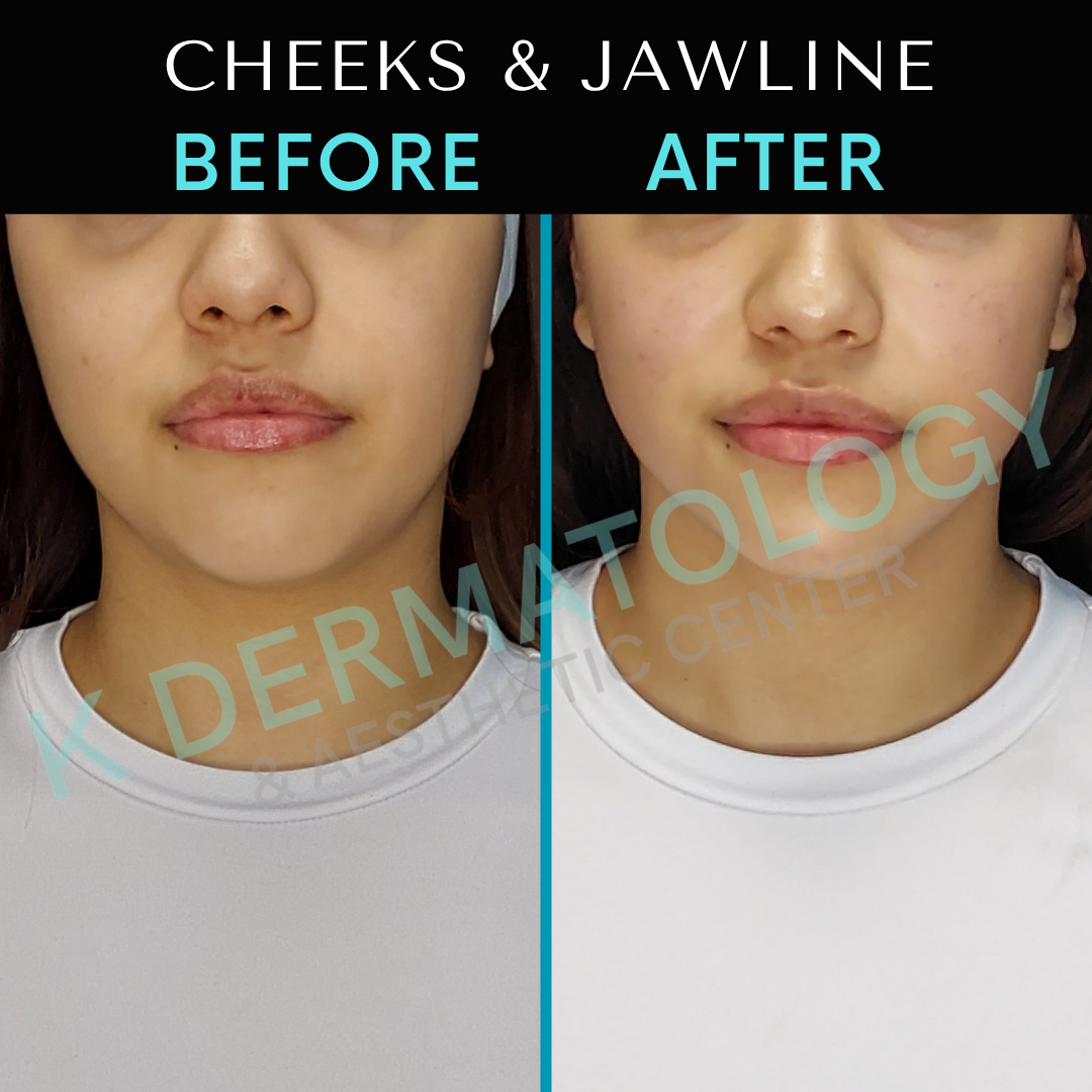 Before-and-after cheek and jawline comparison of a lower face, split by a vertical line.