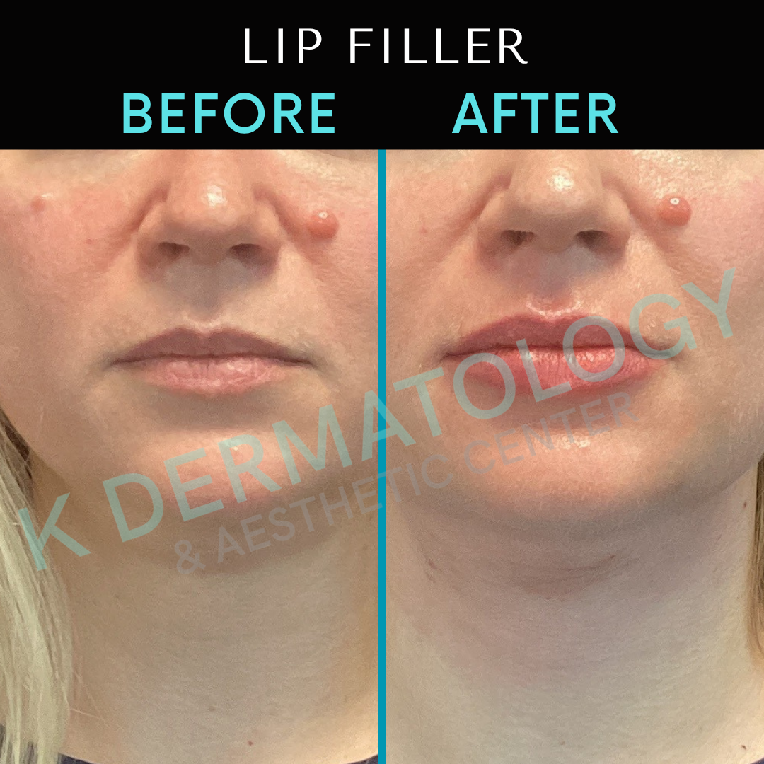 Lip filler before-and-after split image, showing fuller lips and chin on the right.