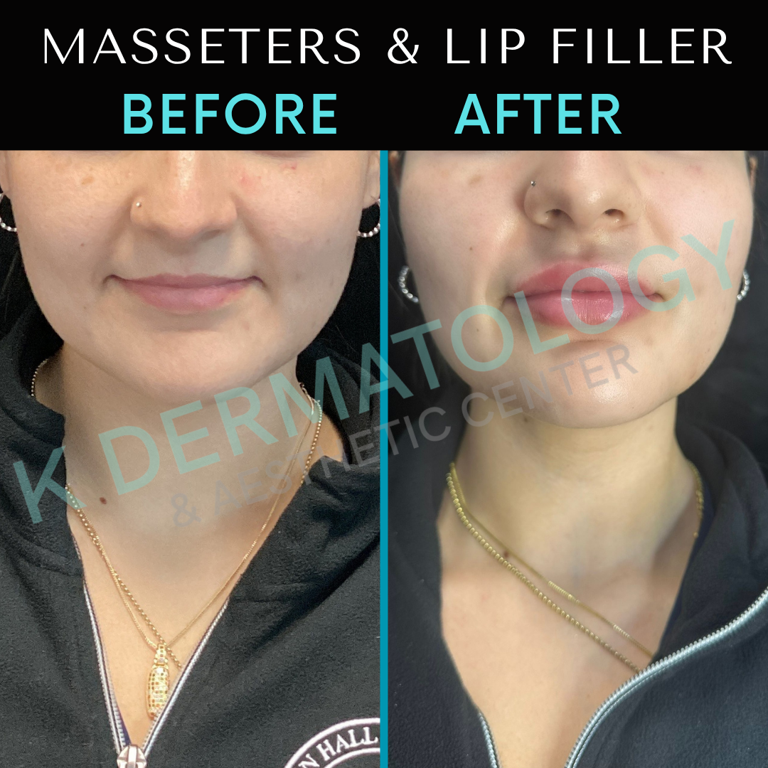 Before-and-after cosmetic treatment of lower face and lips, split-screen with labels and watermark.