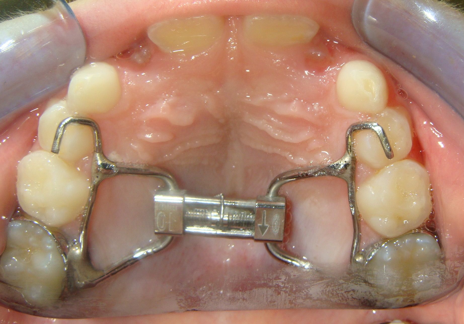 Unlocking the Potential of Orthodontic Expanders: Timing, Types, and Beyond