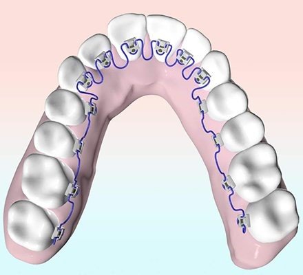 Family Orthodontist & Orthodontic, Invisalign Aligners, Braces ...