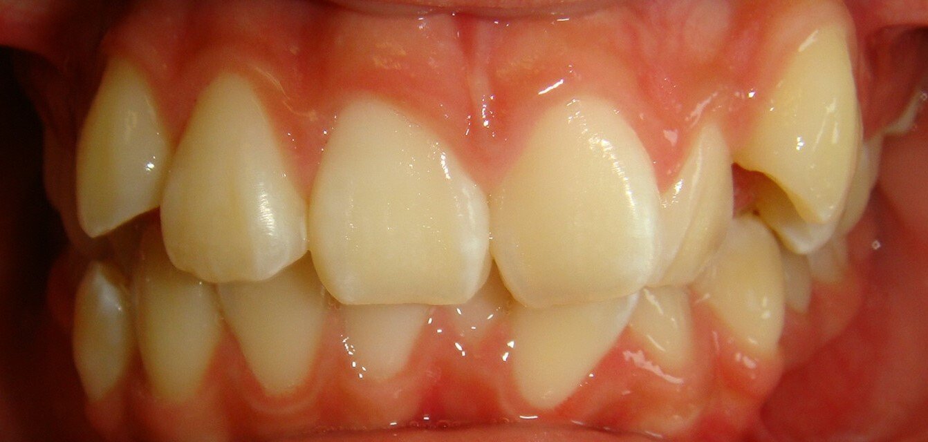 Dental Crowding Causes and Treatment