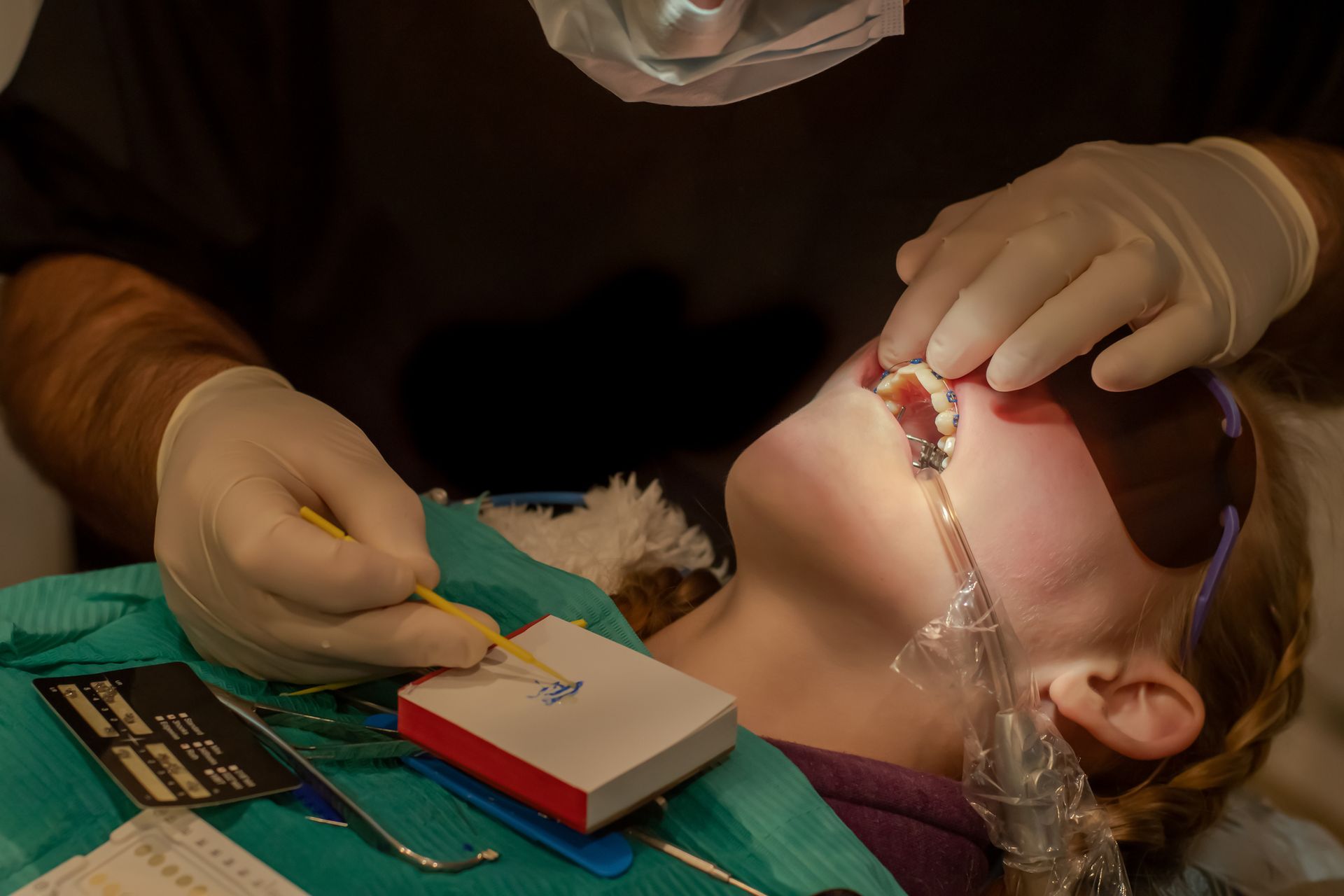 At Rosen Orthodontics in Buffalo Grove, IL, an orthodontist applies metal braces with dental glue to create a perfect smile.