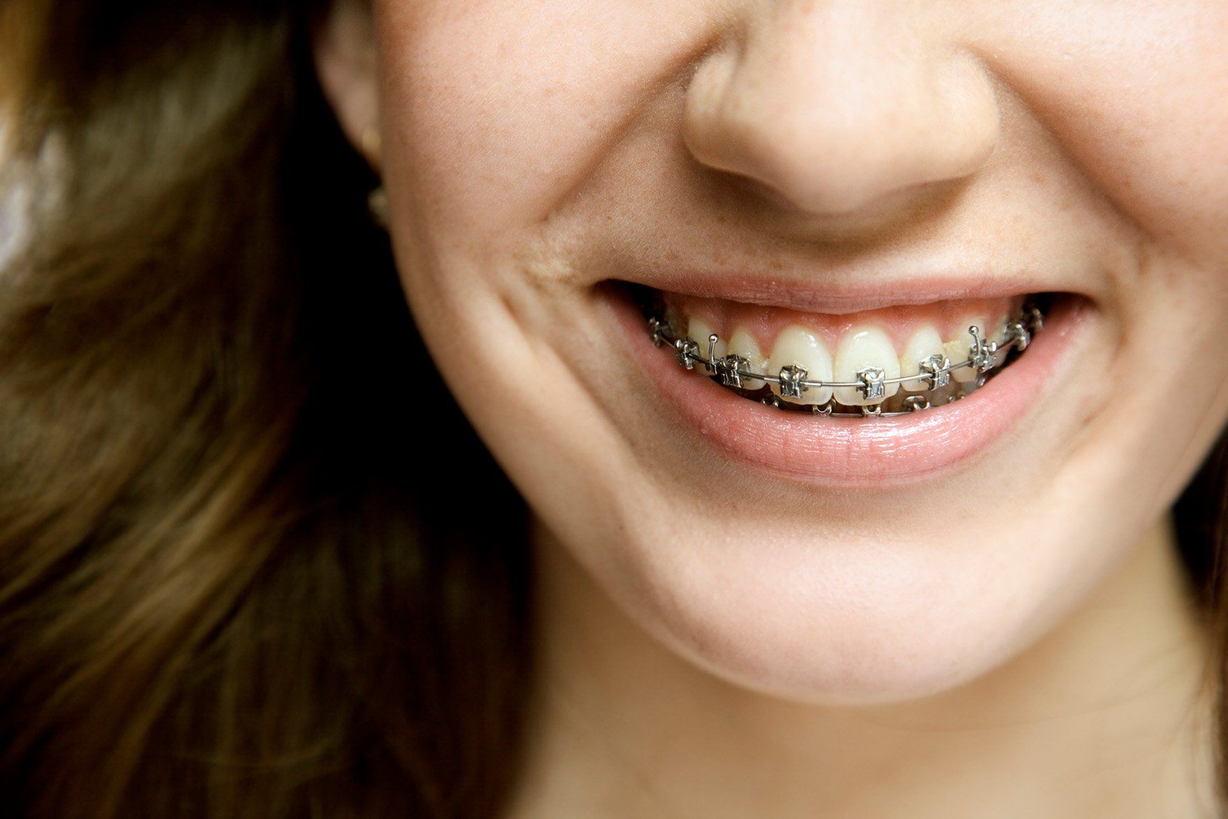 Damon braces — Buffalo Grove, IL — Rosen Orthodontics