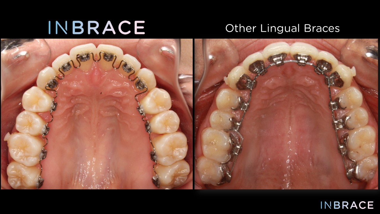A picture of a person 's teeth with inbrace and other lingual braces