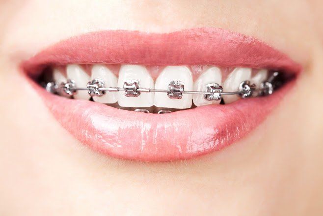 Benefits of damon braces — Buffalo Grove, IL — Rosen Orthodontics Benefits of damon braces — Buffalo Grove, IL — Rosen Orthodontics