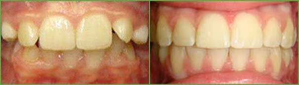 Crowding teeth before and after — Buffalo Grove, IL — Rosen Orthodontics Crowding teeth before and after — Buffalo Grove, IL — Rosen Orthodontics