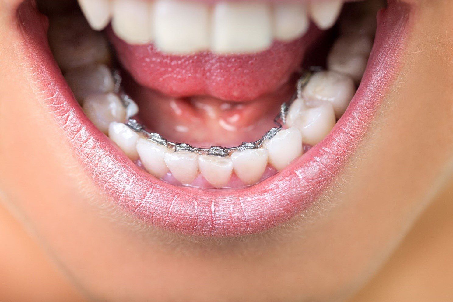 Lingual braces — Buffalo Grove, IL — Rosen Orthodontics Lingual braces — Buffalo Grove, IL — Rosen Orthodontics