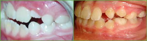 Under bite teeth before and after — Buffalo Grove, IL — Rosen Orthodontics Under bite teeth before and after — Buffalo Grove, IL — Rosen Orthodontics