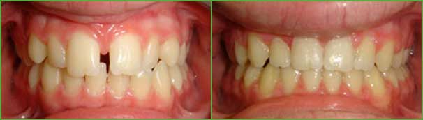 Spacing teeth before and after — Buffalo Grove, IL — Rosen Orthodontics Spacing teeth before and after — Buffalo Grove, IL — Rosen Orthodontics
