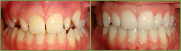 Impacted cuspids before and after — Buffalo Grove, IL — Rosen Orthodontics Impacted cuspids before and after — Buffalo Grove, IL — Rosen Orthodontics